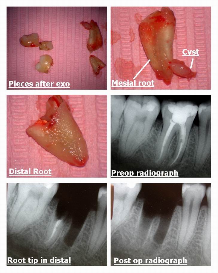 Resize of Extraction of Root pt two.jpg